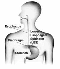 Overview Symptoms Of Gerd About Gerd